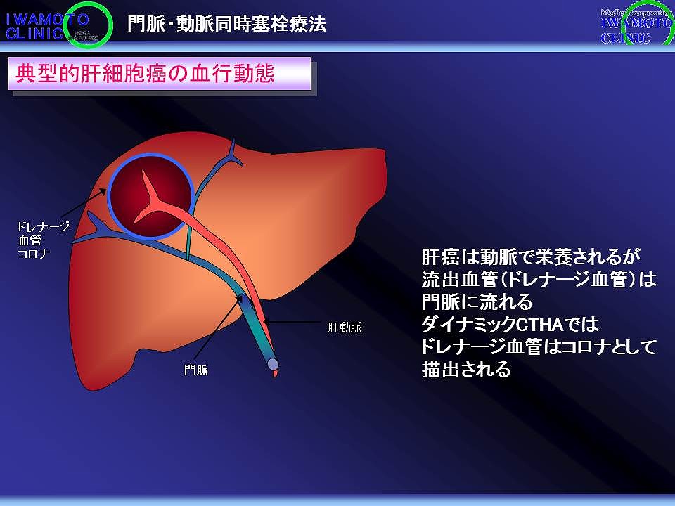 典型的肝癌の血行状態