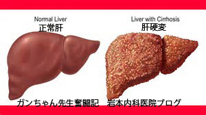 肝硬変の内視鏡検査